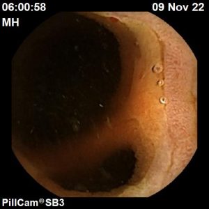 quiz of the month - divertículo de Meckel - capsula endoscopica - owl eyes academy - 01
