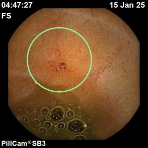 deteccion angiodisplasia - capsula endoscopica - owl eyes academy