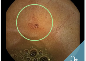 deteccion angiodisplasia - capsula endoscopica - owl eyes academy - 01