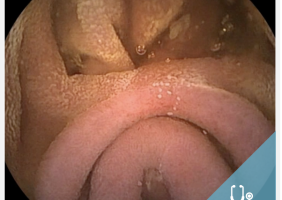 Duplicación del tracto gastrointestinal - owl eyes academy - 2