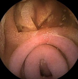 Gastrointestinal tract duplication - owl eyes academy - 1