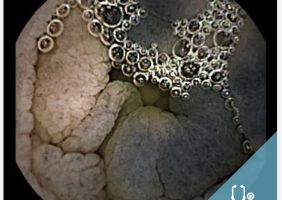 black findings in capsule endoscopy-fernandez-urien- owl eyes academy-02.jpg