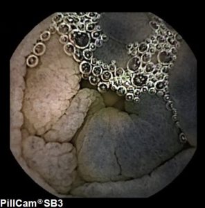 black findings in capsule endoscopy-fernandez-urien- owl eyes academy-02.jpg